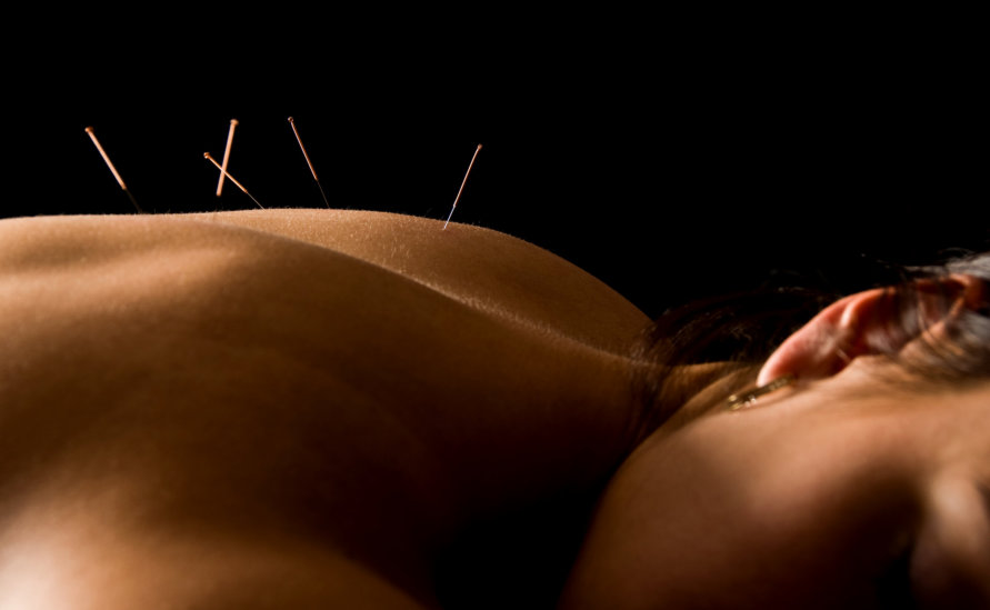woman having a session of acupuncture on her body