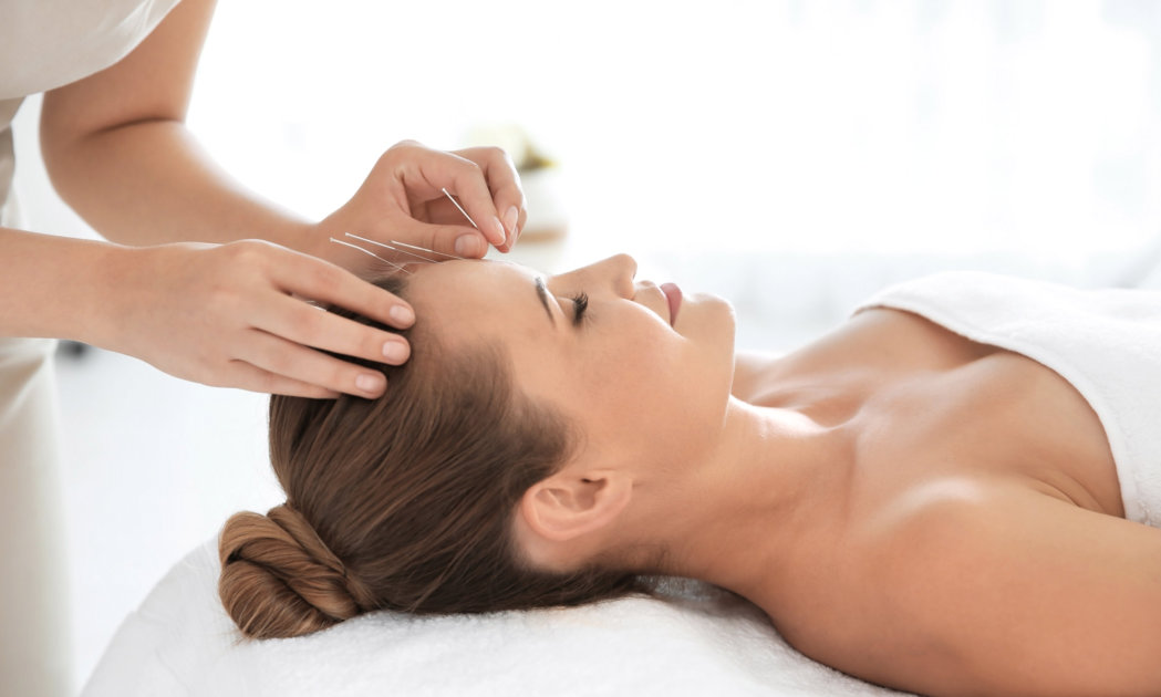 woman having a session of acupuncture