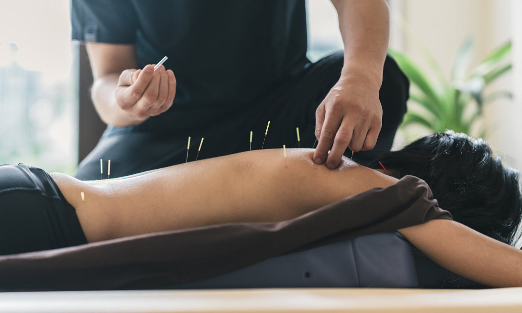 man having a session of acupunture