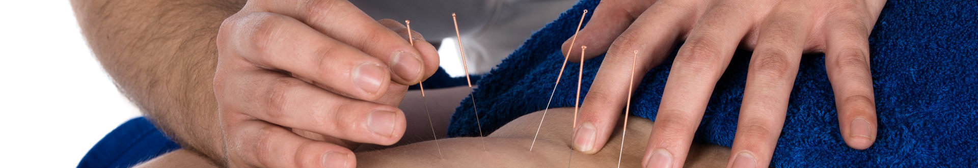 an adult man physiotherapist is doing acupuncture on the back of a patient