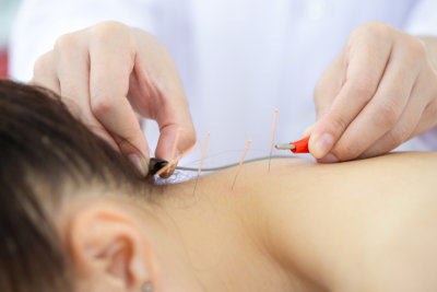 Acupuncturist inserts needles into a person's neck skin to reduce neck pain.