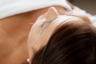 facial acupuncture of a woman