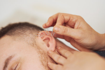 Auricular Acupuncture