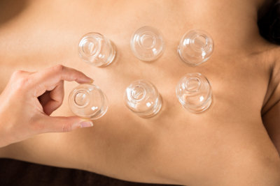 therapists hand is placing the cups on the woman back
