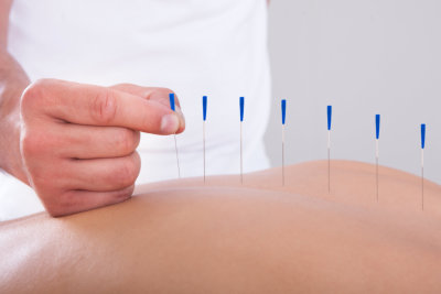 a physiotherapist is doing acupuncture on the back of a patient