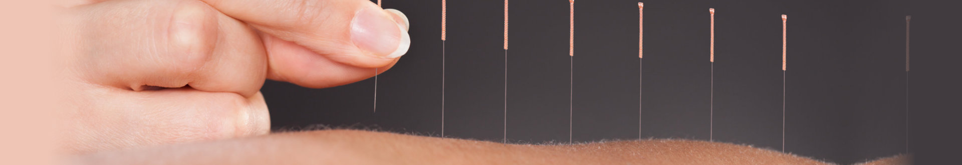 Person Getting An Acupuncture Treatment At Spa