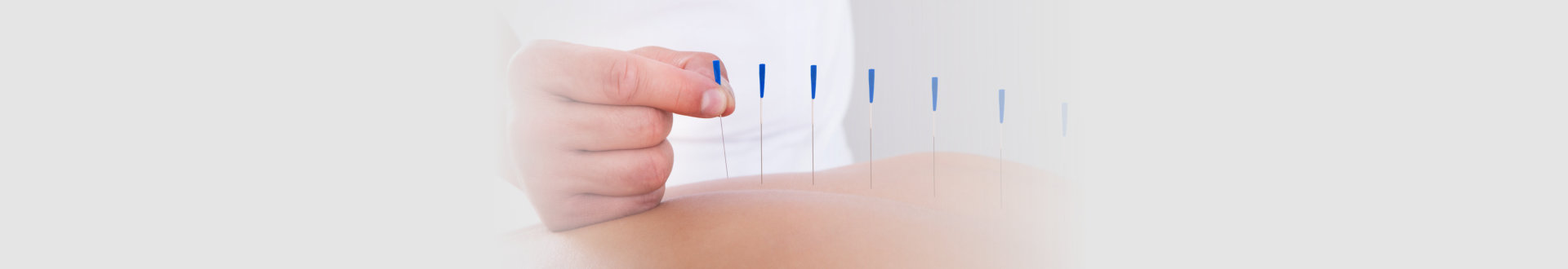 a physiotherapist is doing acupuncture on the back of a patient