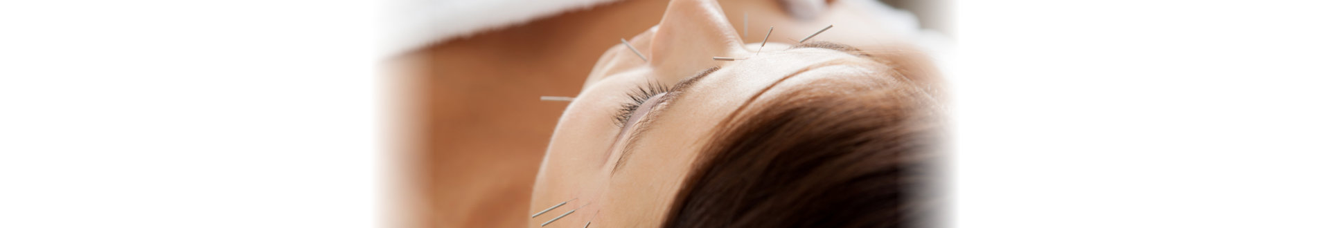 facial acupuncture of a woman