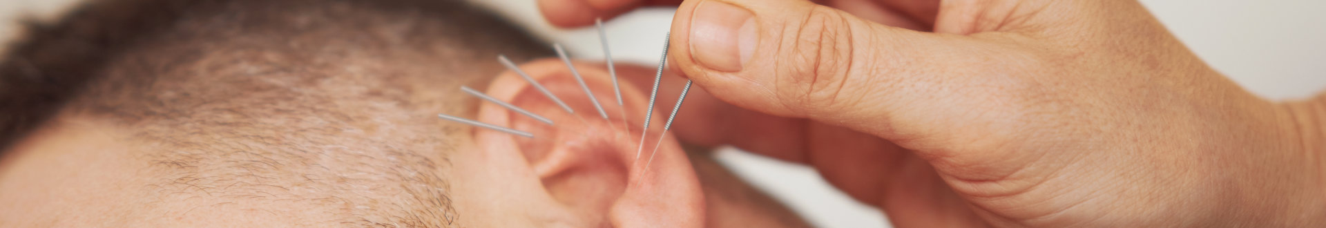Auricular Acupuncture